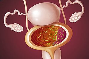 Bakterielle Zystitis bei einer Frau