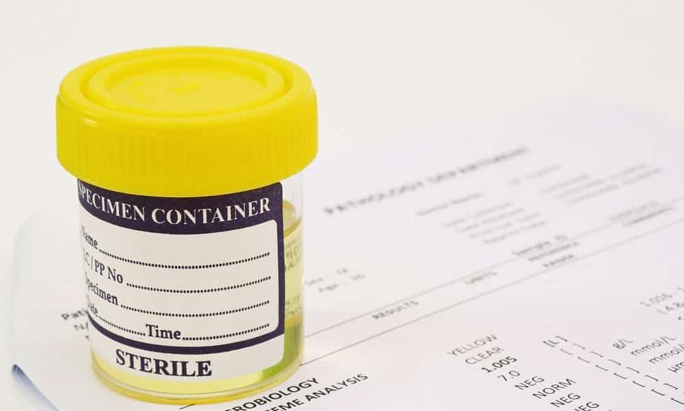 Vor der Einnahme von Antibiotika muss ein Urintest durchgeführt werden